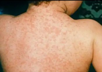 पुणे जिल्ह्यात गोवरचा शिरकाव ; पिंपरी-चिंचवडमध्ये एकाच दिवशी पाच रुग्ण